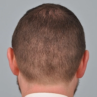 زراعة الشعر بدون سكار في دبي وأبو ظبي والشارقة والعين