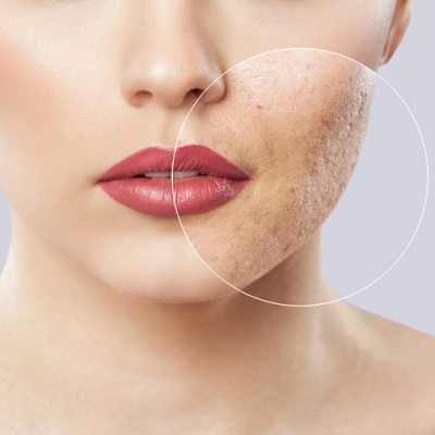 علاج ندبات حب الشباب في دبي علاج ندبات حب الشباب في دبي وأبو ظبي والشارقة والعين