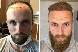 Beard-Hair-Transplant-in-Abu-Dhabi-Al-Ain