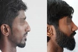 Beard-Hair-Transplant-in-Abu-Dhabi