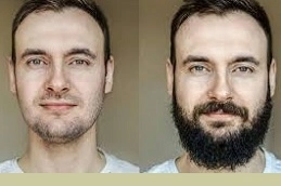 Best-Beard-Transplant-in-Abu-Dhabi