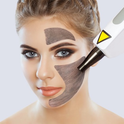 laser carbon peel