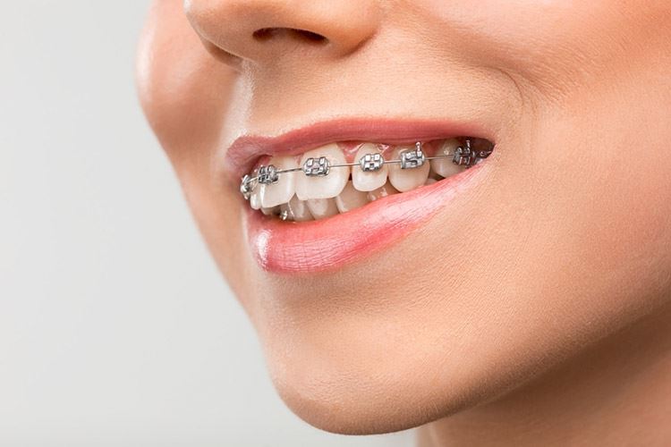 تكلفة علاج الأسنان البارزة في دبي