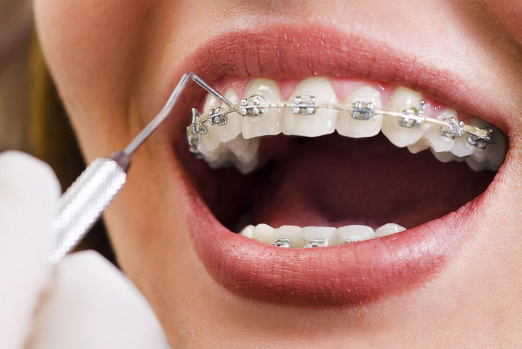 تكلفة علاج الأسنان البارز في دبي وأبو ظبي الشارقة العين