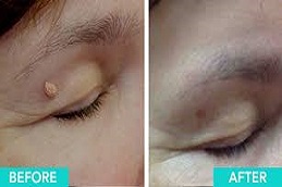 علاج إزالة الثآليل بالليزر في دبي وأبو ظبي والشارقة والعين