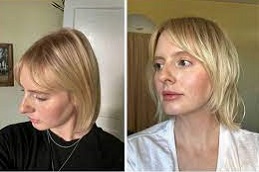 علاج الوخز بالأبر الدقيقة مع حقن البلازما للشعر في دبي وأبو ظبي والشارقة والعين