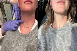 حقن البوتوكس للرقبة في دبي وأبوظبي والشارقة والعين