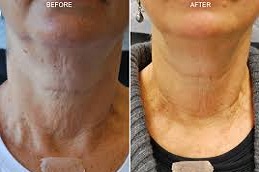 حقن البوتوكس للرقبة في دبي وأبوظبي والشارقة والعين