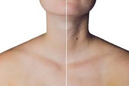 حقن البوتوكس للرقبة في دبي وأبوظبي والشارقة والعين