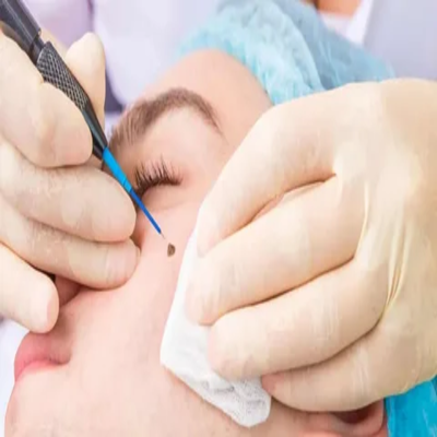 تكلفة إزالة الثآليل بالليزر في الإمارات تكلفة إزالة الثآليل بالليزر في الإمارات