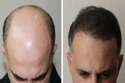 زراعة الشعر الهجين زراعة الشعر الهجين في دبي وأبوظبي والشارقة والعين