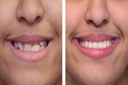 تقويم الاسنان في دبي وأبو ظبي والشارقة والعين