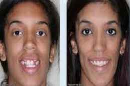 تقويم الاسنان في دبي وأبو ظبي والشارقة والعين