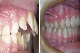 تقويم الاسنان في دبي وأبو ظبي والشارقة والعين