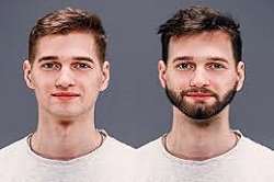 زراعة شعر اللحية في دبي وأبو ظبي والشارقة والعين