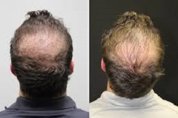  العلاج الوخز بالأبر الدقيقة مع حقن البلازما للشعر في دبي وأبوظبي والشارقة والعين