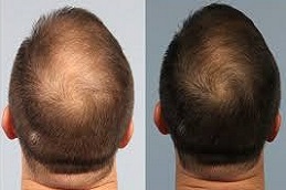  العلاج الوخز بالأبر الدقيقة مع حقن البلازما للشعر في دبي وأبوظبي والشارقة والعين