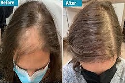  العلاج الوخز بالأبر الدقيقة مع حقن البلازما للشعر في دبي وأبوظبي والشارقة والعين