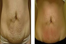 علاج فيلاشيب 3 في دبي علاج فيلاشيب 3 في دبي وأبو ظبي والشارقة والعين