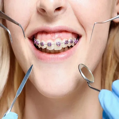 تكلفة علاج تقويم الأسنان الثابت في دبي