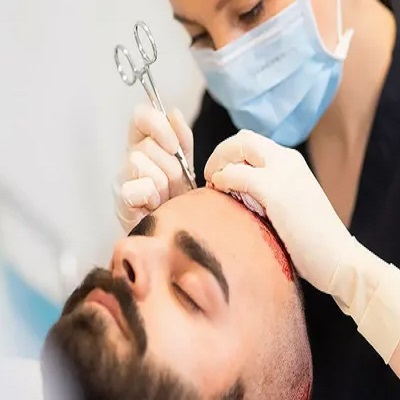 تكلفة زراعة الشعر في الشارقة ودبي