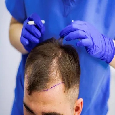 تكلفة زراعة الشعر المباشر DHI في دبي وأبو ظبي والشارقة والعين