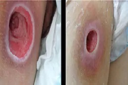 علاج الجروح المزمنة في دبي